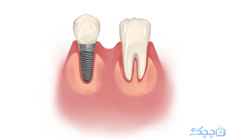 how-is-permanent-tooth-implantation-and-how-long-does-it-take