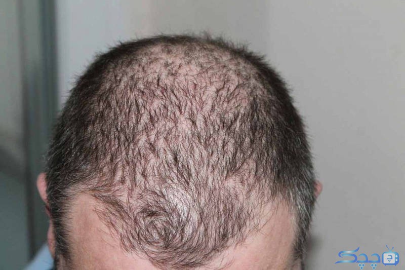Hair-loss-is-a-common-problem!