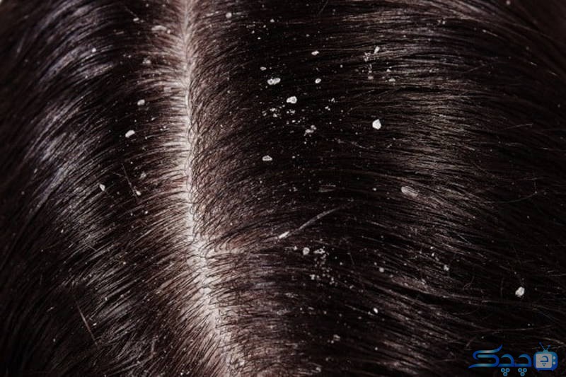 what-should-i-put-on-my-head-to-get-rid-of-dandruff